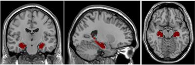 Frontiers | Hippocampal Resting State Functional Connectivity in ...