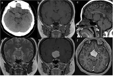 Frontiers | Chordoid Glioma of the Third Ventricle: A Case Report and a ...