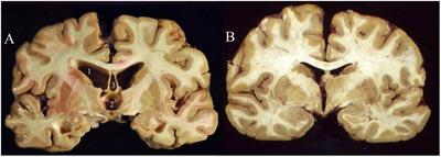 Does CTE directly correlate to violent behavior in athletes? – The Chant