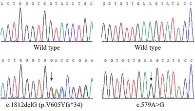 Frontiers | A Synonymous Variant c.579A>G in the ETFDH Gene Caused Exon ...