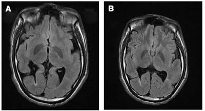 Frontiers | An Unusual, Intermediate-Sized Lesion Affecting Motor ...