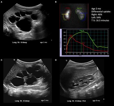 Frontiers | Managing Ureteropelvic Junction Obstruction in the Young Infant