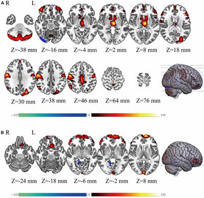 Frontiers | Gender Differences Are Encoded the Structure and Function of the Brain Revealed by Multimodal MRI
