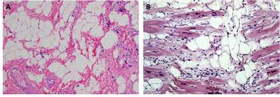 arrhythmogenic right ventricular cardiomyopathy histology