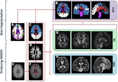 PDF) Microhemorrhage Pathology in Traumatic Brain Injury (TBI): Clinical  and Radiologic Features