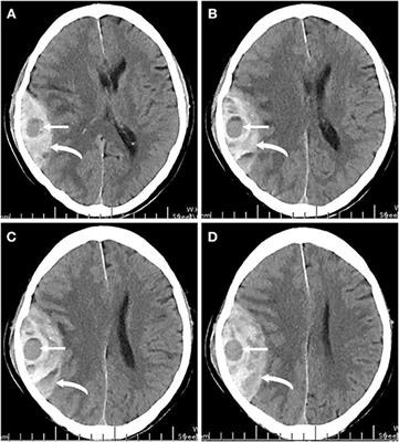 Frontiers | Risk Factors and Prognostic Value of Swirl Sign in ...