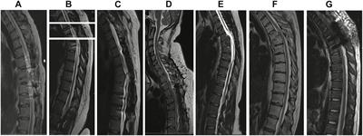 Is It Safe to Work Out With Spinal Cord Stimulation?: Jonathan D