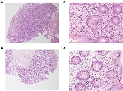 Frontiers | Monogenic Inflammatory Bowel Disease: It's Never Too Late ...