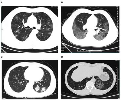 Frontiers | Clinical Characteristics and Eosinophils in Young SARS-CoV ...