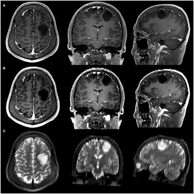 Frontiers | Thin-Slice Magnetic Resonance Imaging-Based Radiomics ...