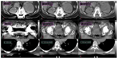 Frontiers  Dual-energy computed tomography to detect early