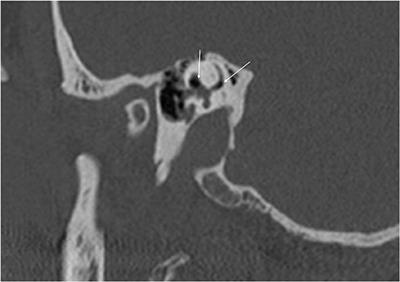 Stapes, Radiology Reference Article