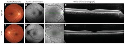 Frontiers | Atypical Retinal Phenotype in a Patient With Alström ...