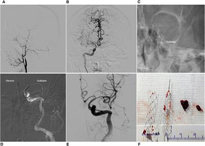 Frontiers | Y-Stent Rescue Technique for Failed Thrombectomy in ...