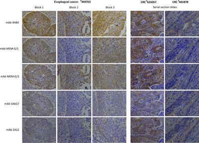 Frontiers | Intratumor Heterogeneity of HLA-G Expression in Cancer Lesions