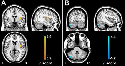 Frontiers Functional Alterations In The Posterior Insula And Cerebellum In Migraine Without Aura A Resting State Mri Study Behavioral Neuroscience