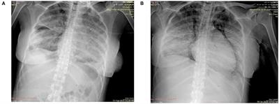 Frontiers | Post Partum Death in a Patient Diagnosed With COVID-19