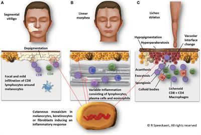 Frontiers | Autoimmunity in Segmental Vitiligo