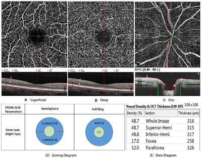 Frontiers Decreased Retinal Vascular Density In Alzheimer S Disease Ad And Mild Cognitive Impairment Mci An Optical Coherence Tomography Angiography Octa Study Frontiers In Aging Neuroscience