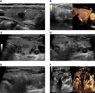 Frontiers | Image-Guided Thermal Ablation as an Alternative to Surgery ...