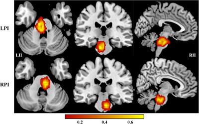 lateral pontine syndrome mri