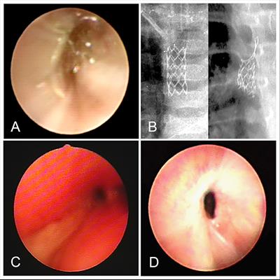 Single-Use Endoscopic Y-Shape Tracheal Stents