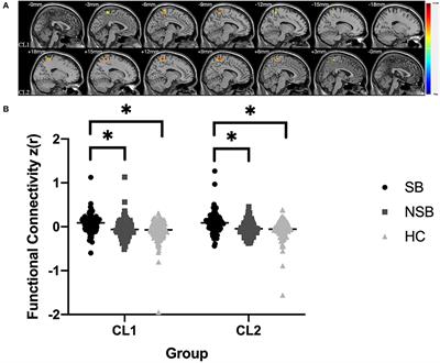 Frontiers Increased Amygdala Paracentral Lobule Precuneus Functional Connectivity Associated With Patients With Mood Disorder And Suicidal Behavior Human Neuroscience