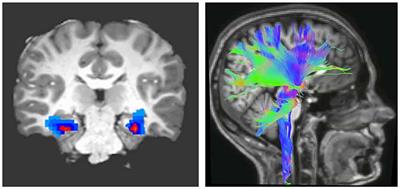 Frontiers | White Matter Plasticity in Anxiety: Disruption of Neural ...