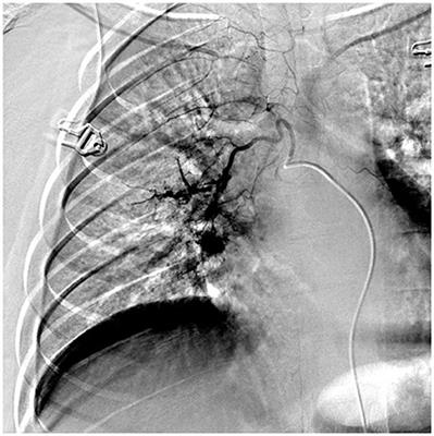 bronchial and pulmonary artery