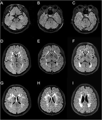 Frontiers | Apolipoprotein E ε4 Is Associated With the Development of ...