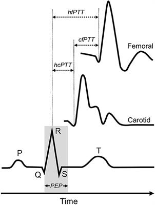 carotid pulse wave