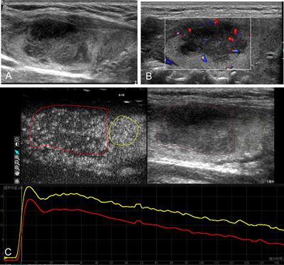 Frontiers | Contrast-Enhanced Ultrasound in the Differential Diagnosis ...