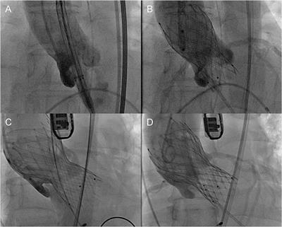 Frontiers | Anatomical Predictors of Valve Malposition During Self ...