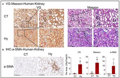 Frontiers Thbs1 Cd47 Modulates The Interaction Of G Catenin With E Cadherin And Participates In Epithelial Mesenchymal Transformation In Lipid Nephrotoxicity Cell And Developmental Biology