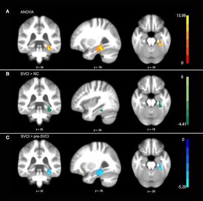 Frontiers | Changes in Gray Matter Asymmetries of the Fusiform and ...