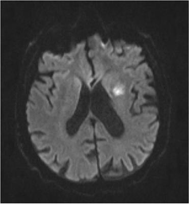 Frontiers | Imaging Patterns of Recurrent Infarction in the Mechanisms ...