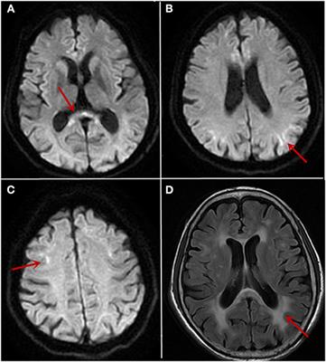 Frontiers | Case Report: Neuronal Intranuclear Inclusion Disease With ...