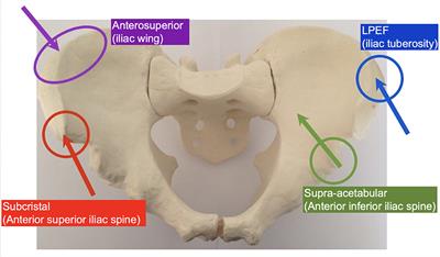 Frontiers | An Alternative Site for Pin Placement in External Fixation ...