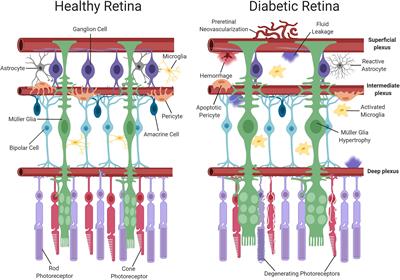 Frontiers The Role Of Lipoxidation In The Pathogenesis Of Diabetic Retinopathy Endocrinology