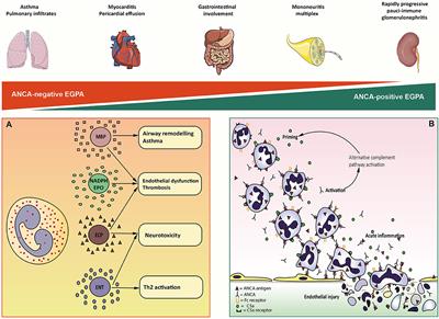 Frontiers | Eosinophilic Granulomatosis With Polyangiitis: Dissecting ...