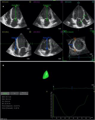 Frontiers  The Predictive Value of Right Ventricular Longitudinal Strain  in Pulmonary Hypertension, Heart Failure, and Valvular Diseases