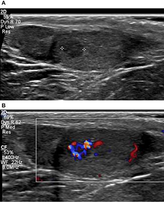 Frontiers | Indeterminate Lesions of the Testis in Klinefelter Syndrome ...