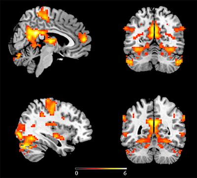 Frontiers | Reduced Inter-hemispheric Resting State Functional ...