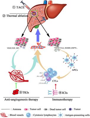 Frontiers | Locoregional Combined With Systemic Therapies for Advanced ...