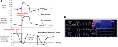 Frontiers | Optimizing Patient–Ventilator Synchrony Utilizing Radar ...