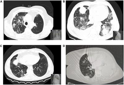 Frontiers | Management of Coronavirus Disease 2019 Patients With Lung ...