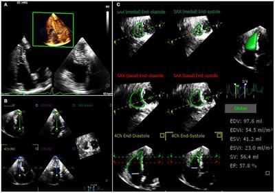 Prognostic Value of Right Ventricular Longitudinal Strain in Patients With  COVID-19