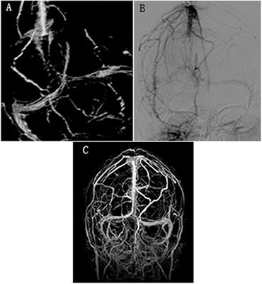 Frontiers | Case Report: Catheter-Directed Endovascular Thrombolysis ...