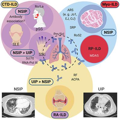 Frontiers | Editorial: Interstitial Lung Disease in the Context of ...