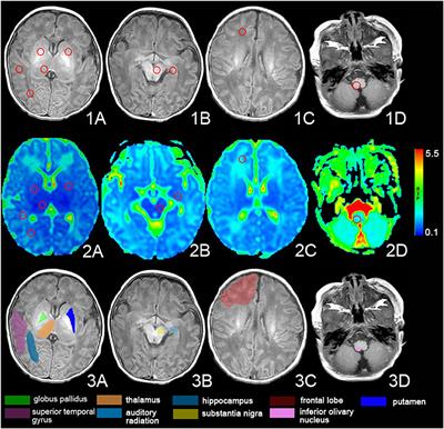 Frontiers | Magnetic Resonance Image of Neonatal Acute Bilirubin ...